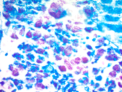 [0316-FLS-1] The Fite's Stain Kit (For Leprosy) - 125 mL